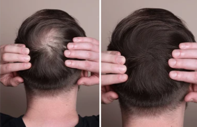 Man applying VERONNI Instant Edge Definer hairline powder with sponge applicator for a fuller hairline