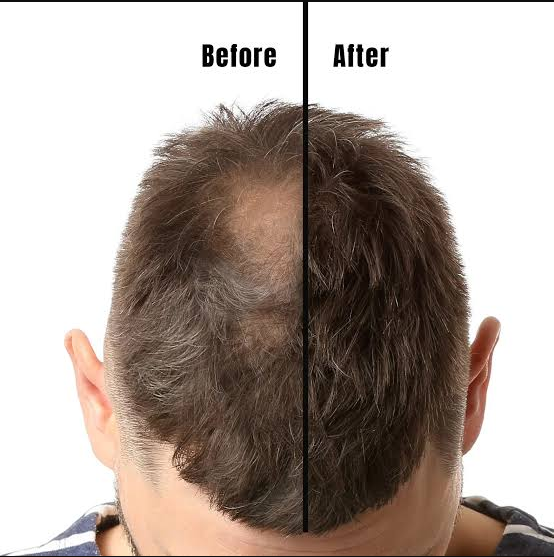 Before and after using VERONNI Precision hairline powder on a receding hairline