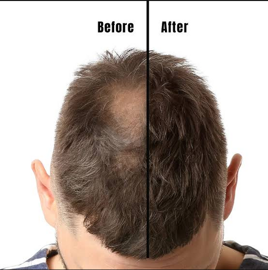 Before and after using VERONNI Precision hairline powder on a receding hairline