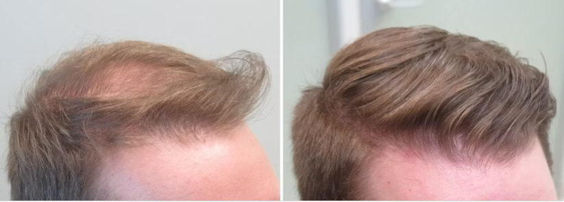 Before and after using VERONNI Hairline Powder to cover a thinning hairline
