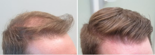 Before and after using VERONNI Hairline Powder to cover a thinning hairline