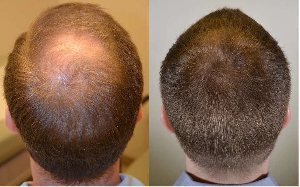 How to Cover Thinning Hair Instantly: Temporary Solutions That Actually Work